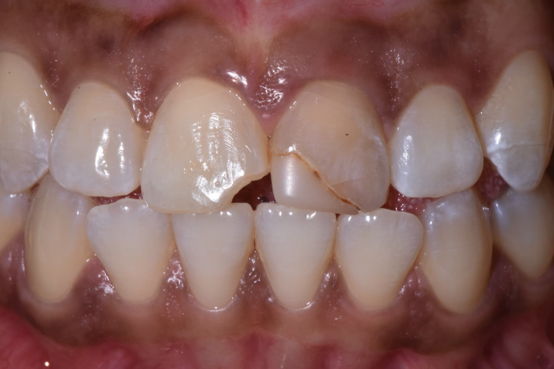 Dental Bonding before and after result — Chipped and worn upper front teeth rebuilt with composite bonding, treated by Dr. Kambez Shukoor in Washington, DC — before treatment