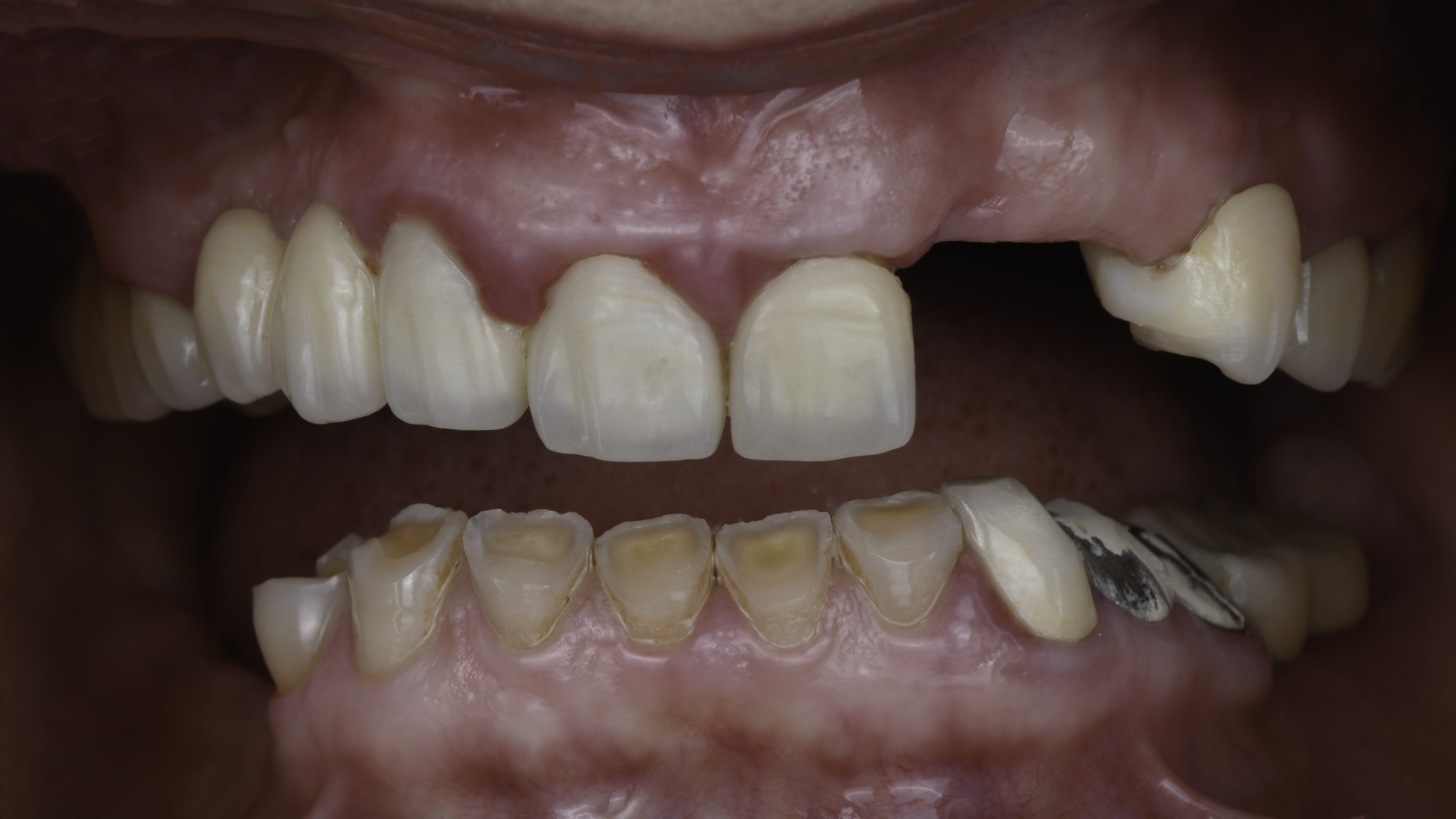 Retracted view — Single tooth implant before and after, Missing tooth replaced with a single dental implant and crown, Washington, DC — before treatment