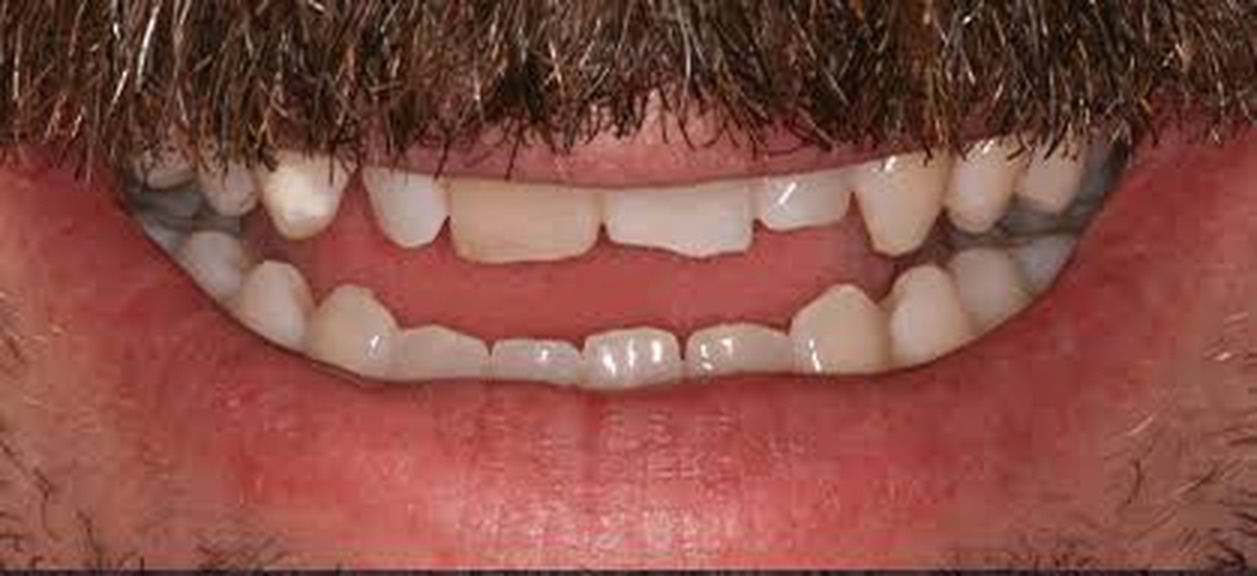 Single missing tooth restored with a dental implant and ceramic crown in Washington, DC — before treatment