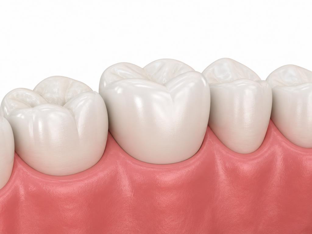 Illustration of a full-coverage ceramic dental crown seated over an entire natural molar with surrounding gums